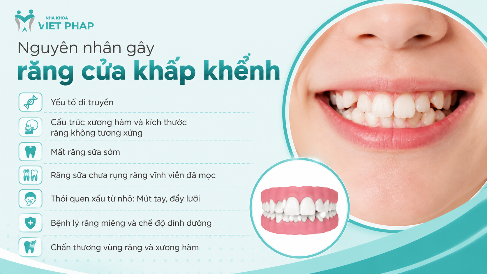 Nguyên nhân gây răng cửa khấp khểnh