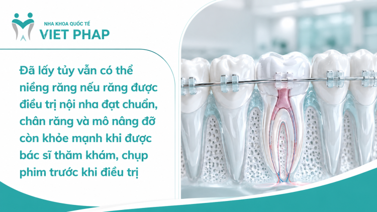Đã lấy tủy vẫn có thể niềng răng nếu răng được điều trị nội nha đạt chuẩn, chân răng và mô nâng đỡ còn khỏe mạnh khi được bác sĩ thăm khám, chụp phim trước khi điều trị