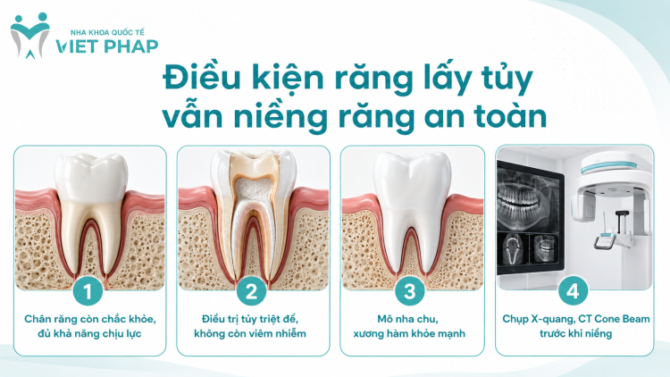 Điều kiện răng lấy tủy vẫn niềng răng an toàn