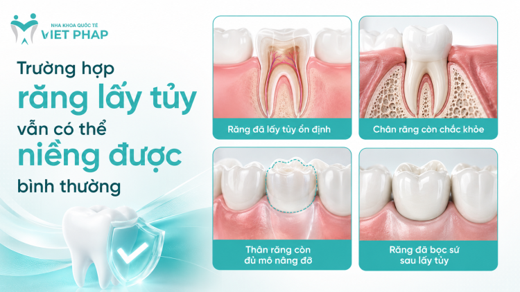 Trường hợp răng lấy tủy vẫn có thể niềng được bình thường 