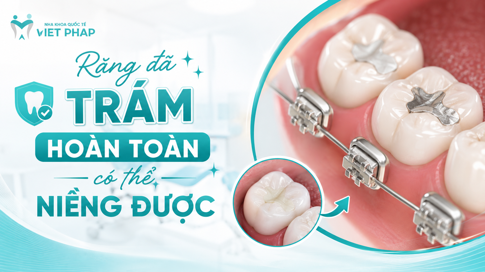 Răng đã trám hoàn toàn có thể niềng được