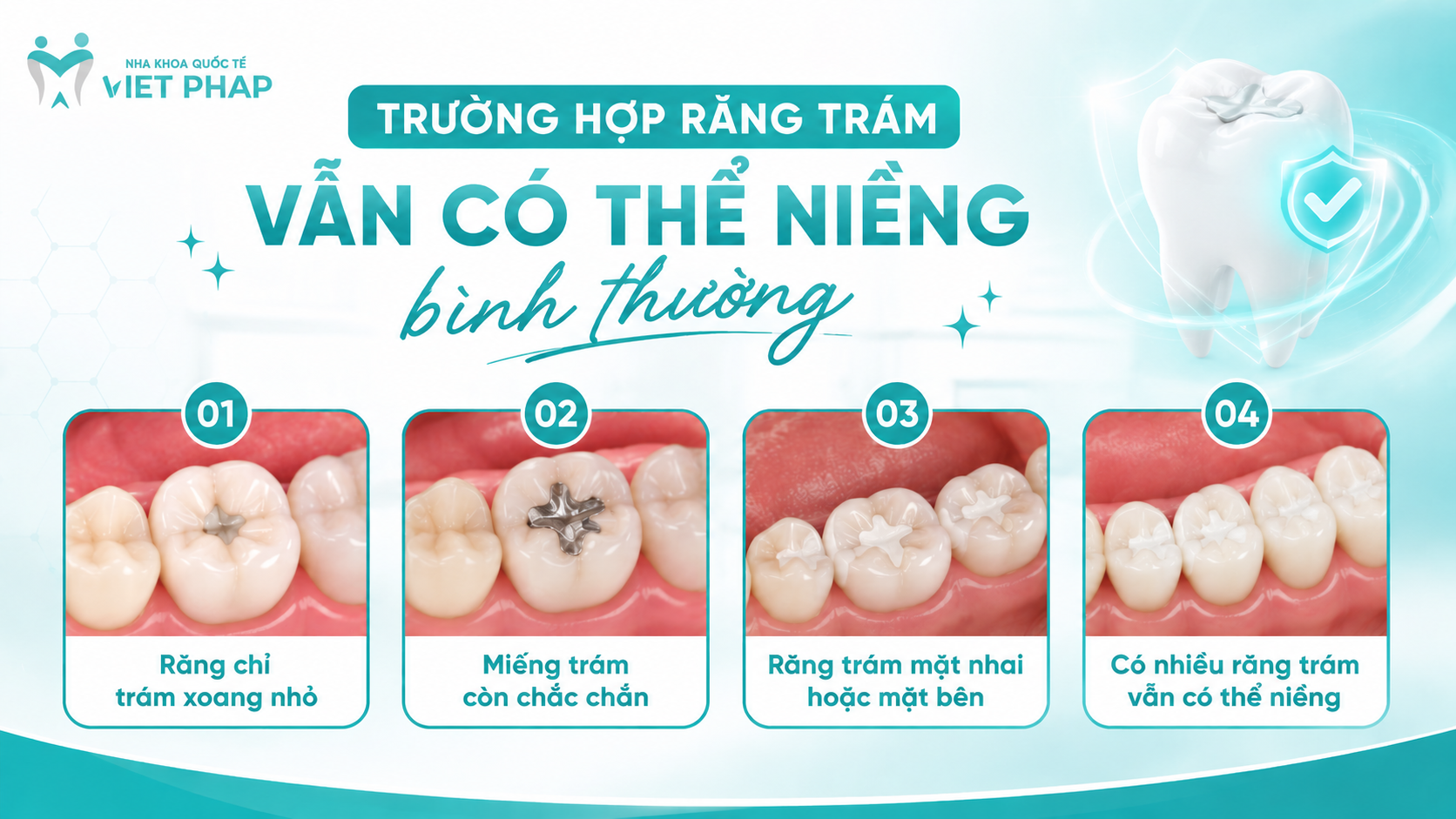 Trường hợp răng trám vẫn có thể niềng bình thường