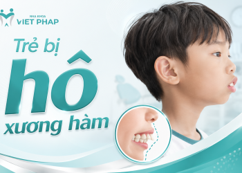Trẻ bị hô xương hàm phải làm sao? Dấu hiệu, tác hại và giải pháp điều trị hiệu quả