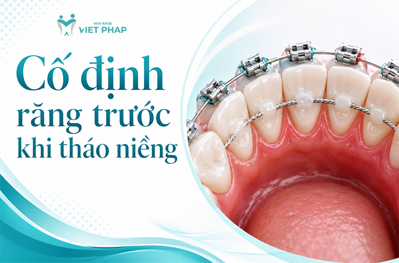 Lý do cố định răng trước khi tháo niềng