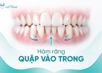 Hàm răng quặp vào trong