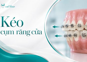 Kéo cụm răng cửa khi nào? Thời gian, vấn đề thường gặp và cách khắc phục hiệu quả