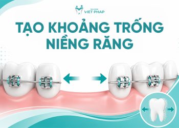 [Giải đáp] Tạo khoảng trống niềng răng để làm gì? Lý do, phương pháp, rủi ro và lưu ý quan trọng
