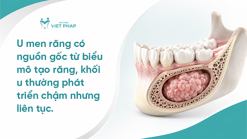 U men răng có nguồn gốc từ biểu mô tạo răng, khối u thường phát triển chậm nhưng liên tục