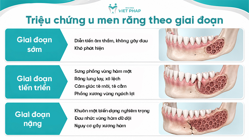 Triệu chứng u men răng theo giai đoạn