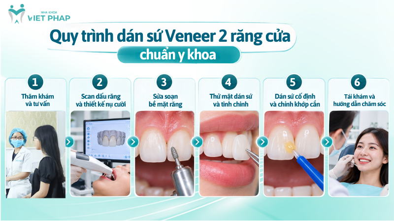 dan su veneer 2 rang 5 Quy trình dán sứ Veneer 2 răng cửa chuẩn y khoa