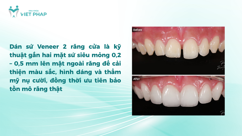 dan su veneer 2 rang Dán sứ Veneer 2 răng cửa là kỹ thuật gắn hai mặt sứ siêu mỏng 0,2 – 0,5 mm lên mặt ngoài răng để cải thiện màu sắc, hình dáng và thẩm mỹ nụ cười, đồng thời ưu tiên bảo tồn mô răng thật