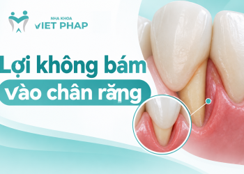 Lợi không bám vào chân răng