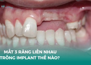 Mất 3 răng liền nhau trồng implant thế nào