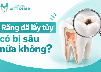 Răng đã lấy tủy có bị sâu nữa không