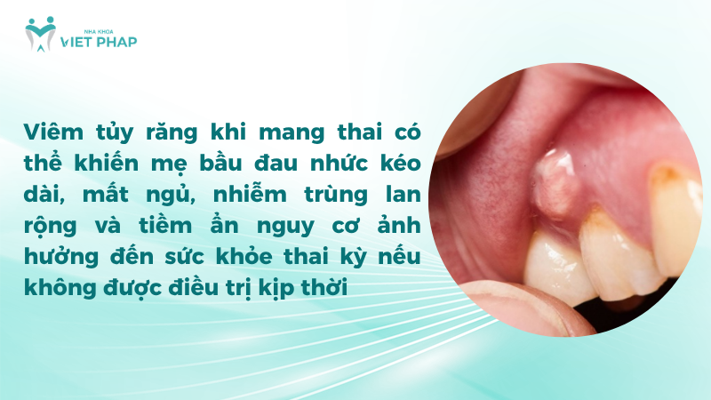 ba bau bi viem tuy rang 3 Viêm tủy răng khi mang thai có thể khiến mẹ bầu đau nhức kéo dài, mất ngủ, nhiễm trùng lan rộng và tiềm ẩn nguy cơ ảnh hưởng đến sức khỏe thai kỳ nếu không được điều trị kịp thời