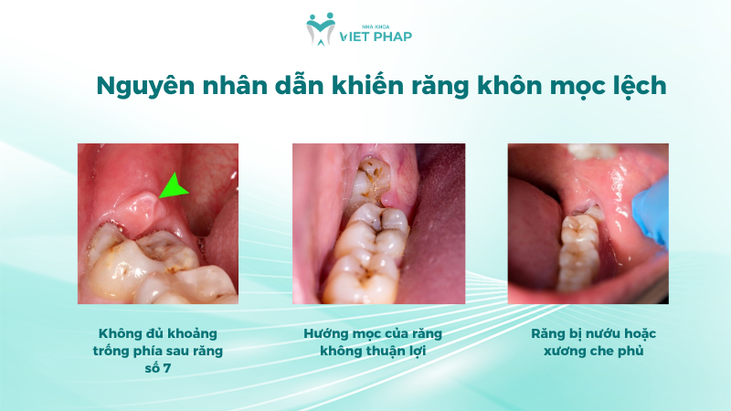 Nguyên nhân dẫn khiến răng khôn mọc lệch