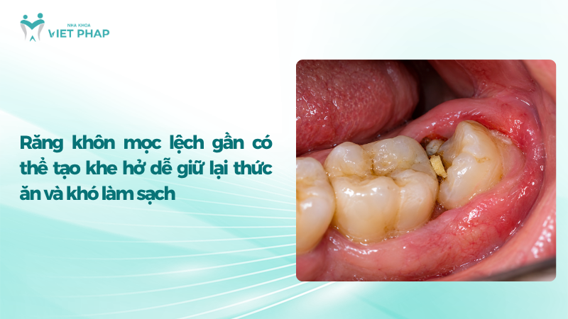 Răng khôn mọc lệch gần có thể tạo khe hở dễ giữ lại thức ăn và khó làm sạch