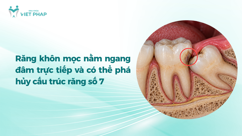 Răng khôn mọc nằm ngang đâm trực tiếp và có thể phá hủy cấu trúc răng số 7