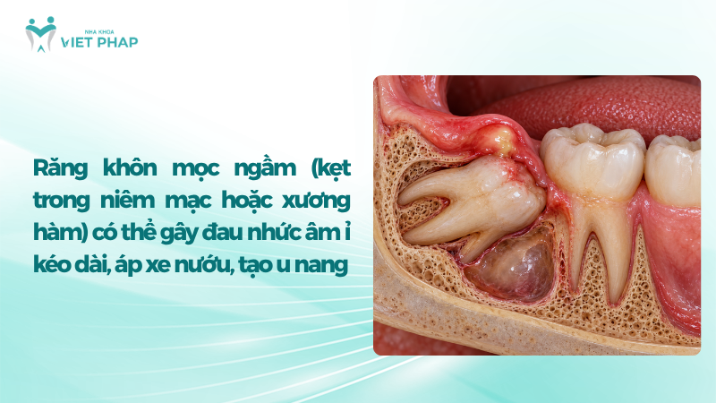Răng khôn mọc ngầm (kẹt trong niêm mạc hoặc xương hàm) có thể gây đau nhức âm ỉ kéo dài, áp xe nướu, tạo u nang