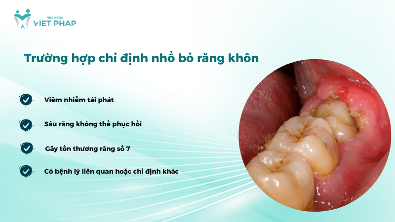 Trường hợp chỉ định nhổ bỏ răng khôn