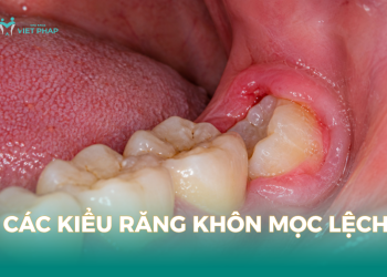 Các kiểu răng khôn mọc lệch