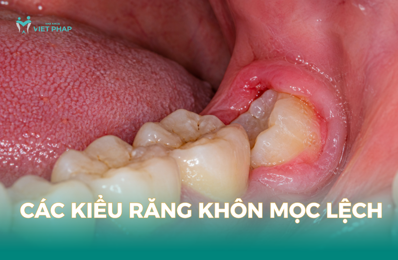 Các kiểu răng khôn mọc lệch