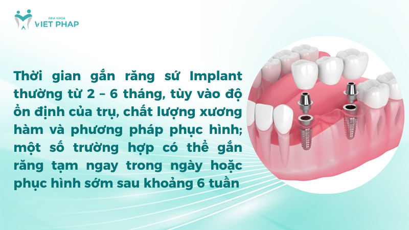 Thời gian gắn răng sứ Implant thường từ 2 – 6 tháng, tùy vào độ ổn định của trụ, chất lượng xương hàm và phương pháp phục hình; một số trường hợp có thể gắn răng tạm ngay trong ngày hoặc phục hình sớm sau khoảng 6 tuần