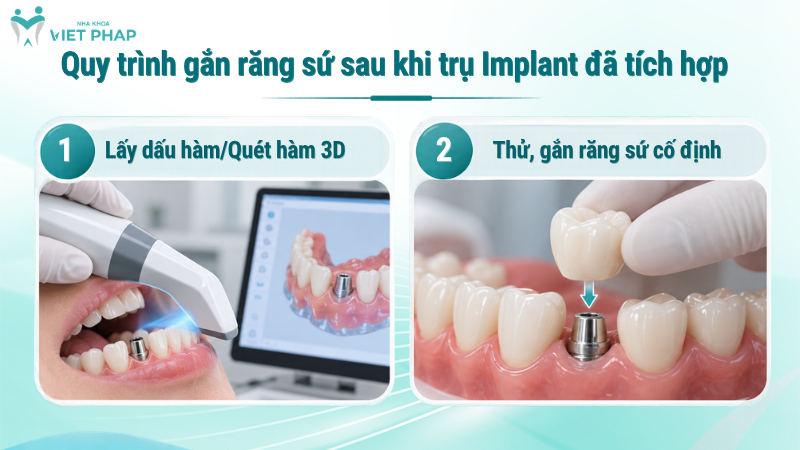 Quy trình gắn răng sứ sau khi trụ Implant đã tích hợp