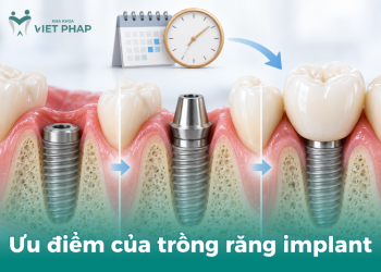 Cấy Implant bao lâu thì gắn răng sứ