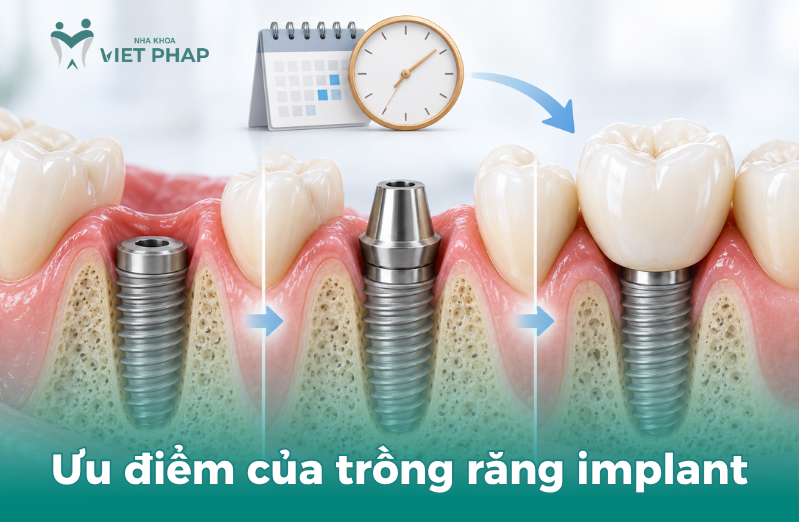 Cấy Implant bao lâu thì gắn răng sứ