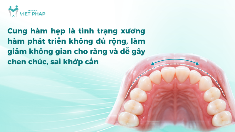 cung ham hep Cung hàm hẹp là tình trạng xương hàm phát triển không đủ rộng, làm giảm không gian cho răng và dễ gây chen chúc, sai khớp cắn
