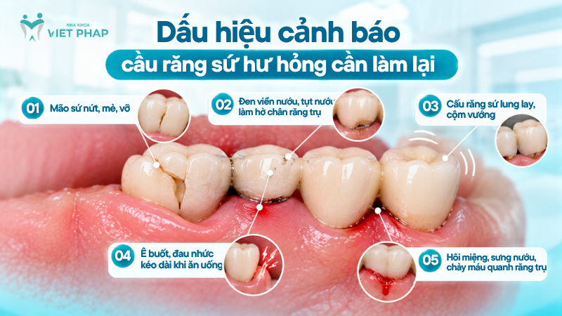 Các dấu hiệu cảnh báo cầu răng sứ hư hỏng cần làm lại