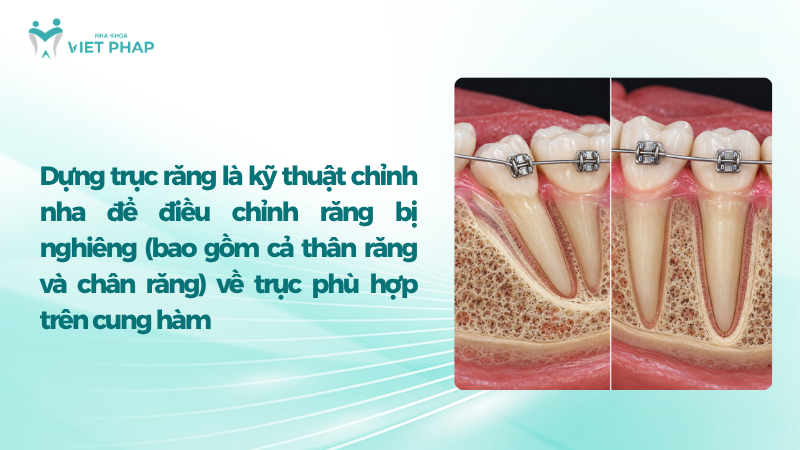 dung truc rang 1 Dựng trục răng là kỹ thuật chỉnh nha để điều chỉnh răng bị nghiêng (bao gồm cả thân răng và chân răng) về trục phù hợp trên cung hàm