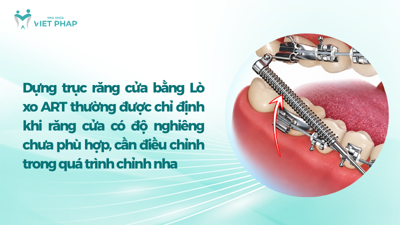 dung truc rang 4 Dựng trục răng cửa bằng Lò xo ART thường được chỉ định khi răng cửa có độ nghiêng chưa phù hợp, cần điều chỉnh trong quá trình chỉnh nha