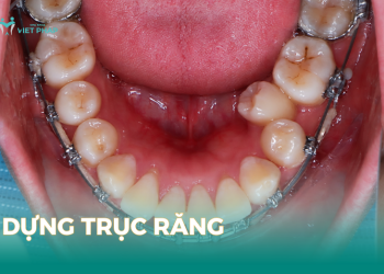 Dựng trục răng