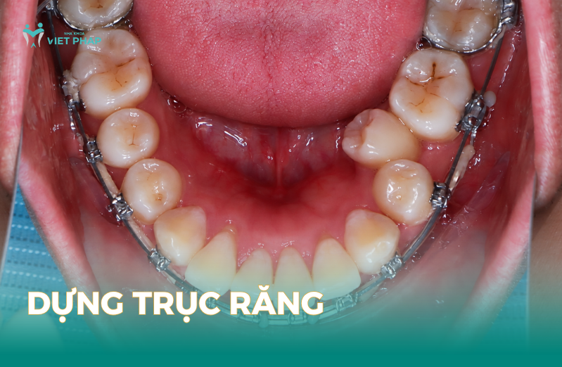 Dựng trục răng