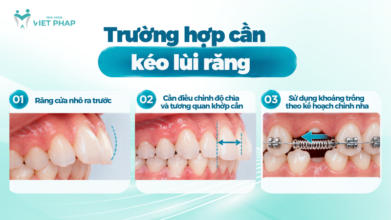 Trường hợp cần kéo lùi răng