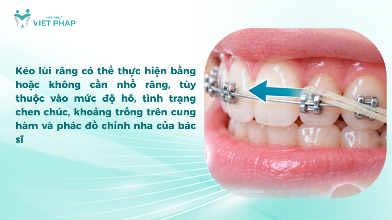 Kéo lùi răng có thể thực hiện bằng hoặc không cần nhổ răng, tùy thuộc vào mức độ hô, tình trạng chen chúc, khoảng trống trên cung hàm và phác đồ chỉnh nha của bác sĩ