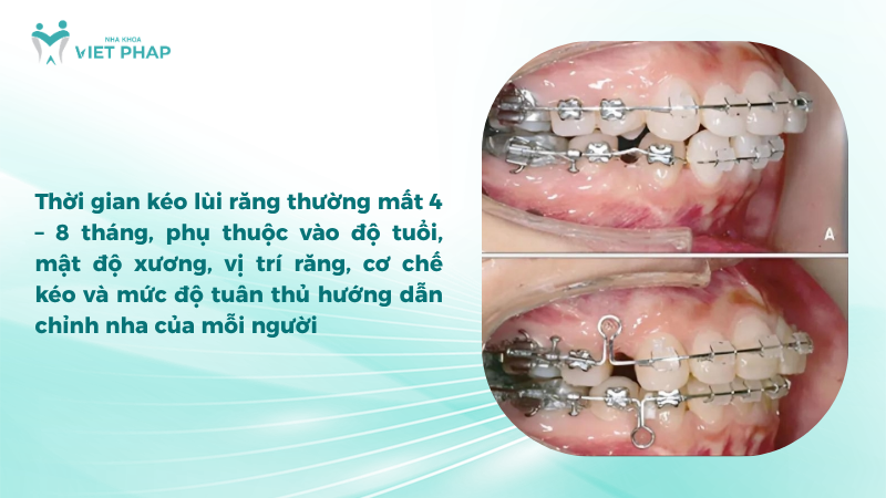 Thời gian kéo lùi răng thường mất 4 – 8 tháng, phụ thuộc vào độ tuổi, mật độ xương, vị trí răng, cơ chế kéo và mức độ tuân thủ hướng dẫn chỉnh nha của mỗi người
