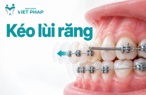 Kéo lùi răng khi nào? Có cần nhổ răng không, thời gian kéo lùi và cách chăm sóc