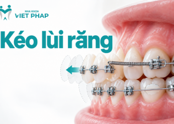 Kéo lùi răng khi nào? Có cần nhổ răng không, thời gian kéo lùi và cách chăm sóc
