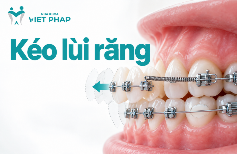 Kéo lùi răng khi nào? Có cần nhổ răng không, thời gian kéo lùi và cách chăm sóc