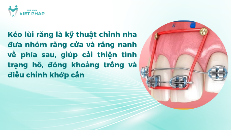 Kéo lùi răng là kỹ thuật chỉnh nha đưa nhóm răng cửa và răng nanh về phía sau, giúp cải thiện tình trạng hô, đóng khoảng trống và điều chỉnh khớp cắn