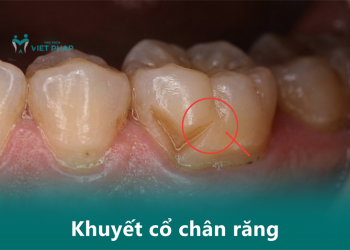 Khuyết cổ chân răng nguy hiểm không