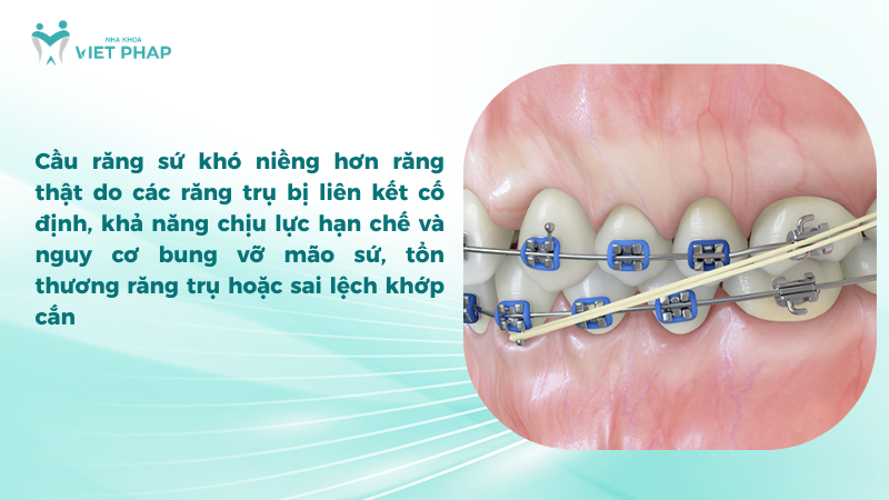 Cầu răng sứ khó niềng hơn răng thật do các răng trụ bị liên kết cố định, khả năng chịu lực hạn chế và nguy cơ bung vỡ mão sứ, tổn thương răng trụ hoặc sai lệch khớp cắn