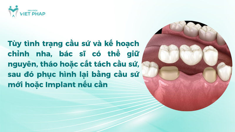 Tùy tình trạng cầu sứ và kế hoạch chỉnh nha, bác sĩ có thể giữ nguyên, tháo hoặc cắt tách cầu sứ, sau đó phục hình lại bằng cầu sứ mới hoặc Implant nếu cần