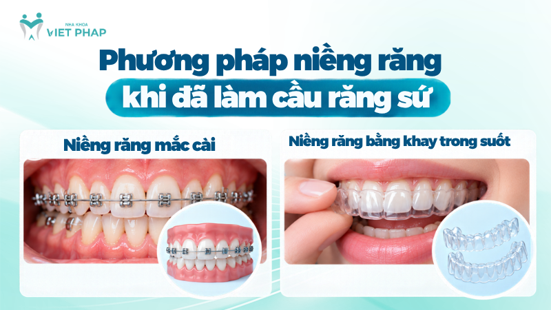 Niềng răng mắc cài và niềng răng bằng khay trong suốt là hai phương pháp có thể cân nhắc khi đã làm cầu răng sứ