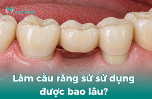 Làm cầu răng sứ sử dụng được bao lâu?