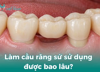 Làm cầu răng sứ sử dụng được bao lâu?