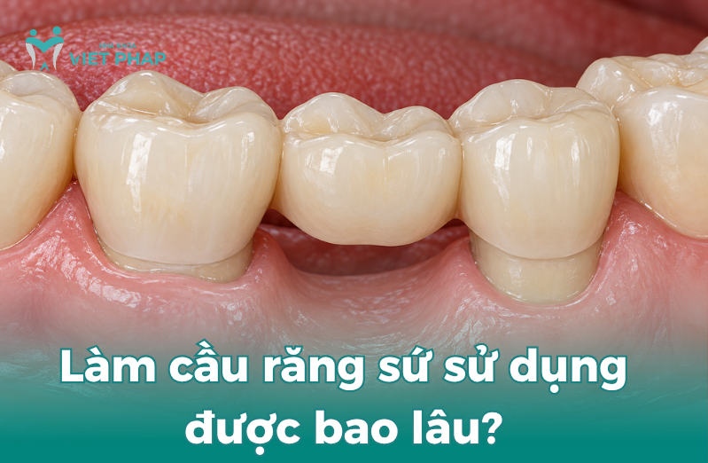 Làm cầu răng sứ sử dụng được bao lâu?